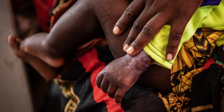 About 6.5 Million People in Somalia at Risk of Severe Hunger From Drought